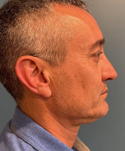 Rhinoplasty Before & After Gallery - Patient 154055 - Image 2