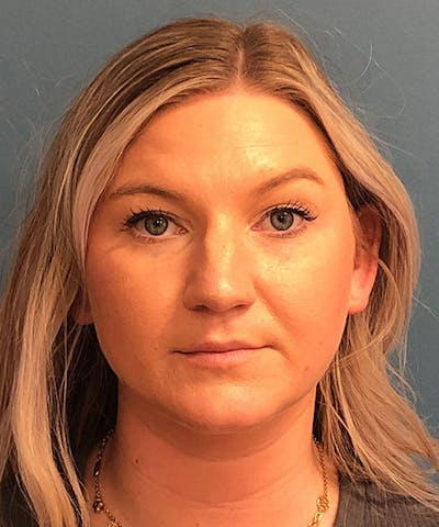 Rhinoplasty Before & After Gallery - Patient 247870 - Image 1