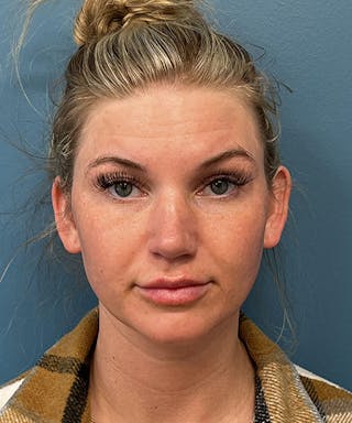 Rhinoplasty Before & After Gallery - Patient 247870 - Image 2