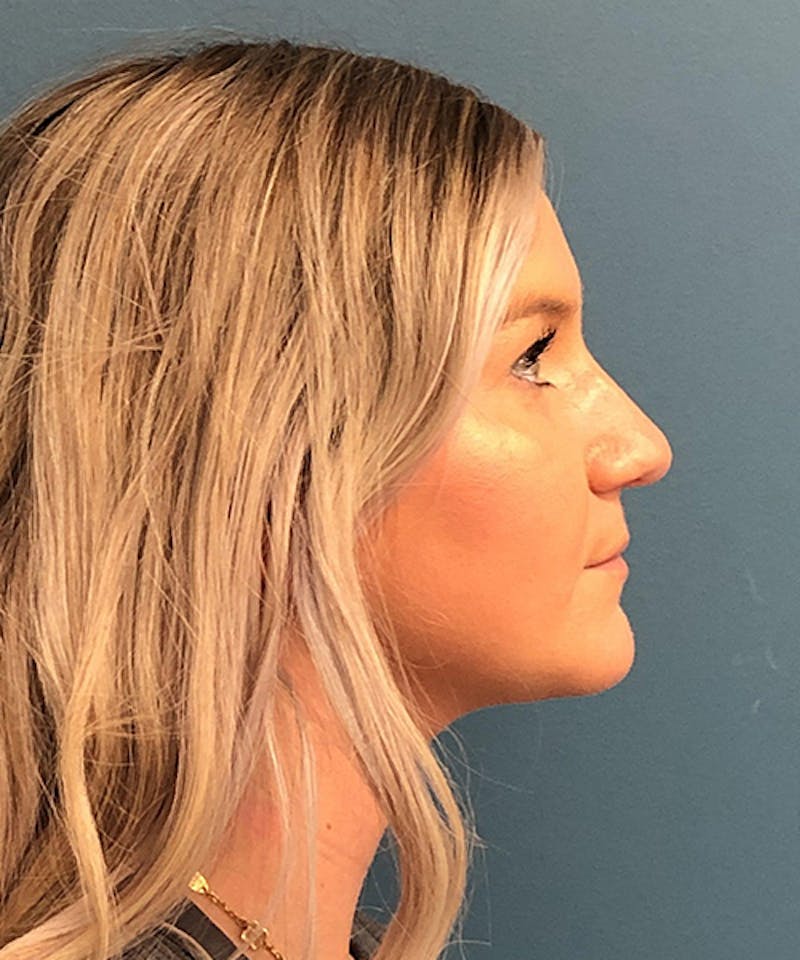 Rhinoplasty Before & After Gallery - Patient 247870 - Image 3