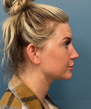 Rhinoplasty Before & After Gallery - Patient 247870 - Image 4