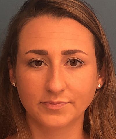 Rhinoplasty Before & After Gallery - Patient 358166 - Image 1