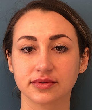 Rhinoplasty Before & After Gallery - Patient 358166 - Image 2