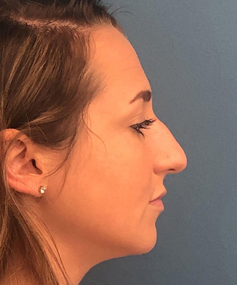 Rhinoplasty Before & After Gallery - Patient 358166 - Image 3