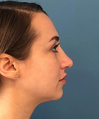 Rhinoplasty Before & After Gallery - Patient 358166 - Image 4