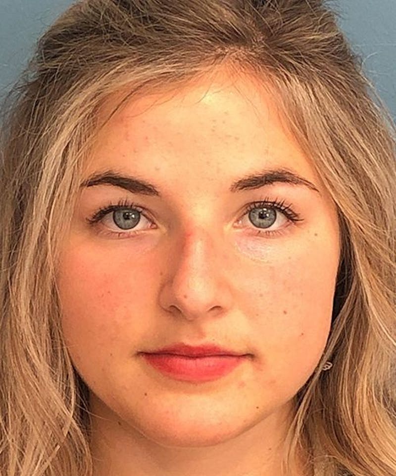 Rhinoplasty Before & After Gallery - Patient 306558 - Image 1