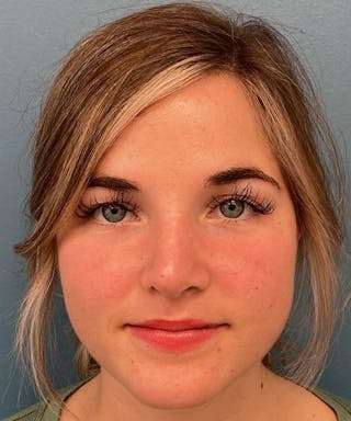 Rhinoplasty Before & After Gallery - Patient 306558 - Image 2