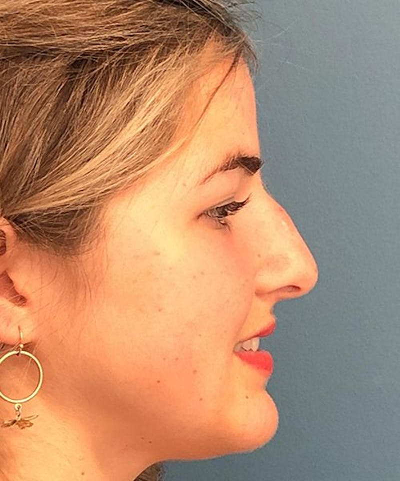 Rhinoplasty Before & After Gallery - Patient 306558 - Image 3