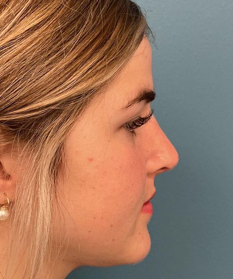 Rhinoplasty Before & After Gallery - Patient 306558 - Image 4