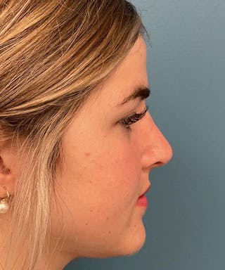 Rhinoplasty Before & After Gallery - Patient 306558 - Image 4