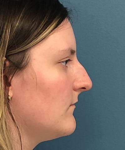 Rhinoplasty Before & After Gallery - Patient 224921 - Image 1