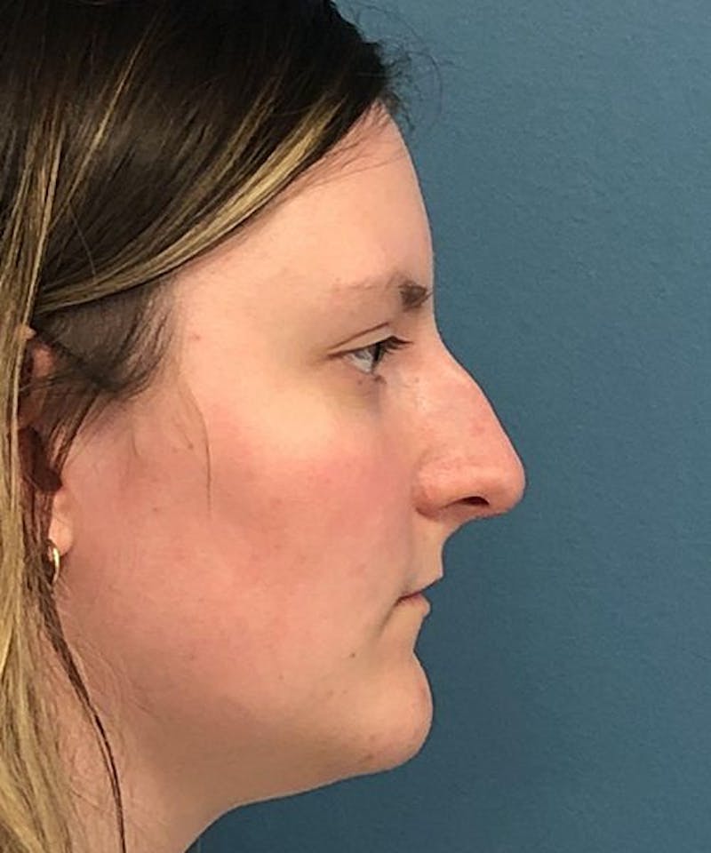 Rhinoplasty Before & After Gallery - Patient 224921 - Image 1