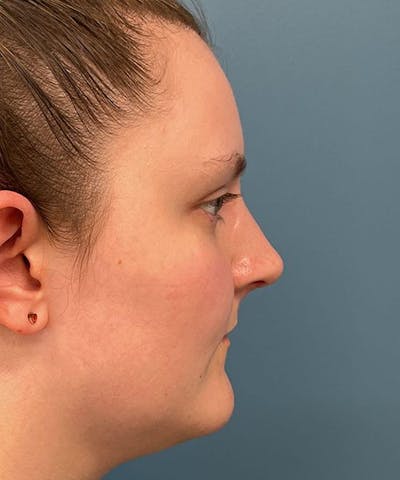Rhinoplasty Before & After Gallery - Patient 224921 - Image 2