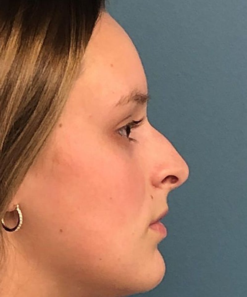 Rhinoplasty Before & After Gallery - Patient 279756 - Image 1