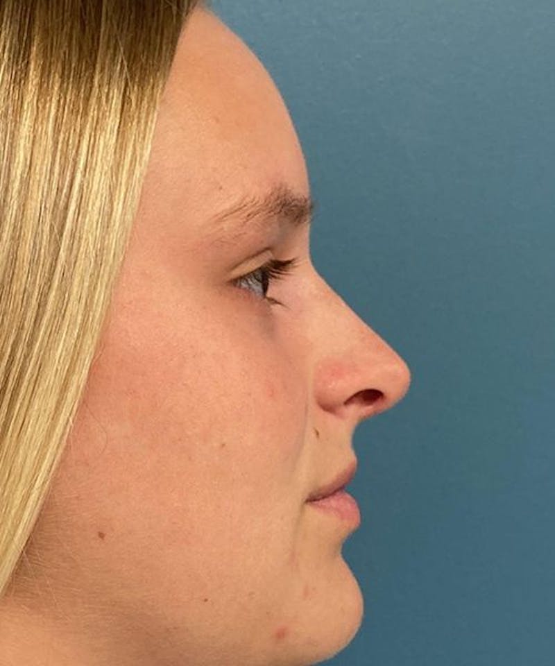 Rhinoplasty Before & After Gallery - Patient 279756 - Image 2