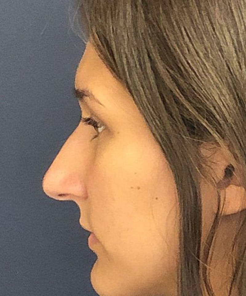 Rhinoplasty Before & After Gallery - Patient 207919 - Image 1