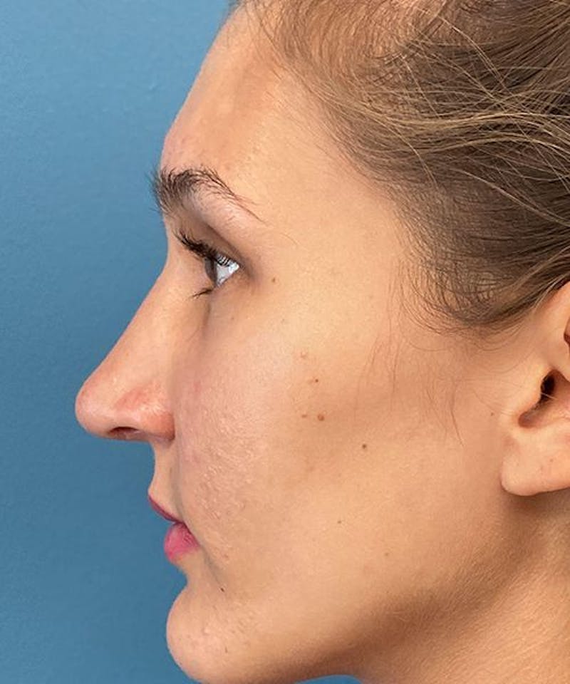 Rhinoplasty Before & After Gallery - Patient 207919 - Image 2