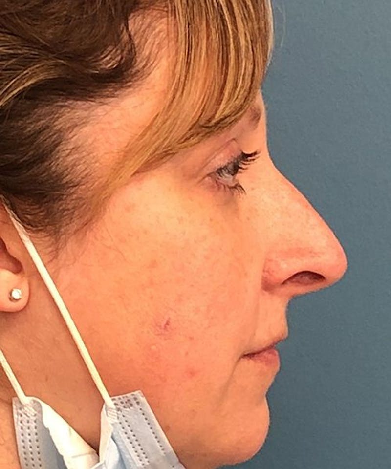 Rhinoplasty Before & After Gallery - Patient 835199 - Image 1
