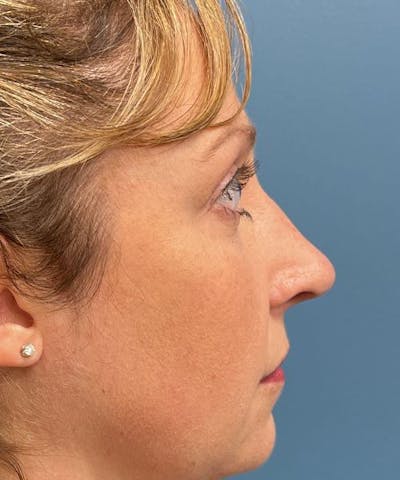 Rhinoplasty Before & After Gallery - Patient 835199 - Image 2