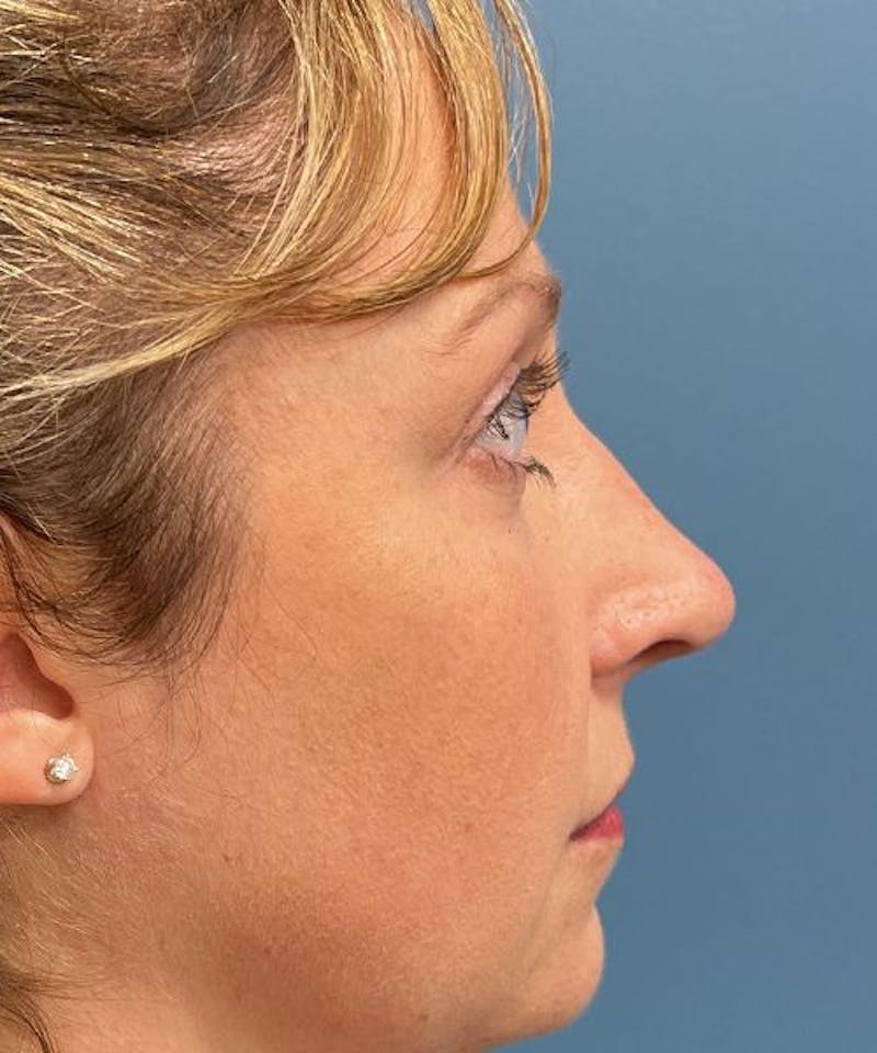 Rhinoplasty Before & After Gallery - Patient 835199 - Image 2