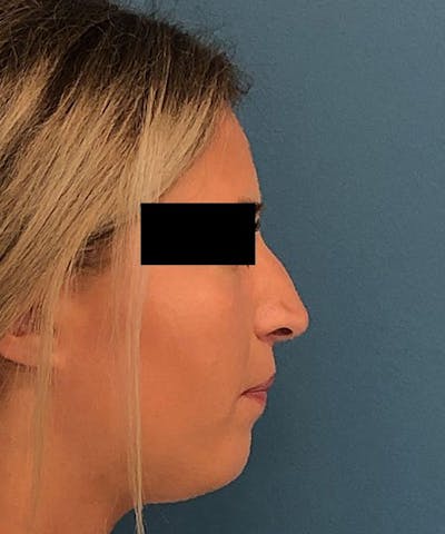 Rhinoplasty Before & After Gallery - Patient 306436 - Image 1