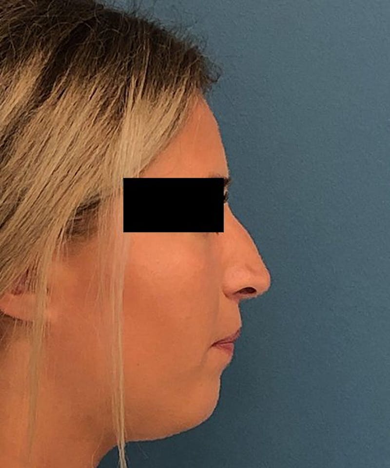 Rhinoplasty Before & After Gallery - Patient 306436 - Image 1