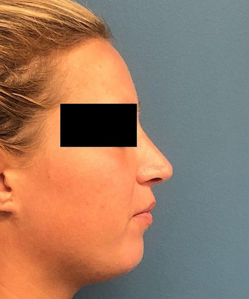 Rhinoplasty Before & After Gallery - Patient 306436 - Image 2