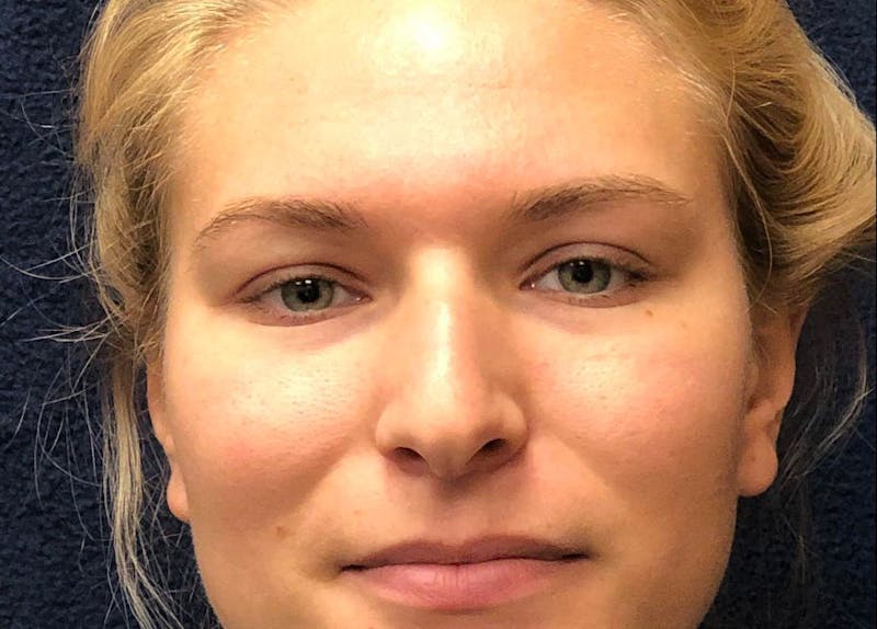Rhinoplasty Before & After Gallery - Patient 422123 - Image 1