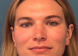 Rhinoplasty Before & After Gallery - Patient 422123 - Image 2