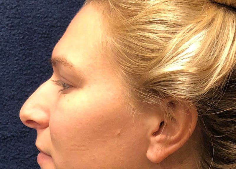 Rhinoplasty Before & After Gallery - Patient 422123 - Image 3