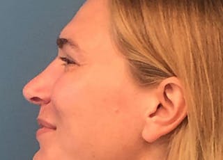Rhinoplasty Before & After Gallery - Patient 422123 - Image 4
