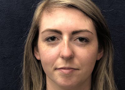 Rhinoplasty Before & After Gallery - Patient 381184 - Image 1