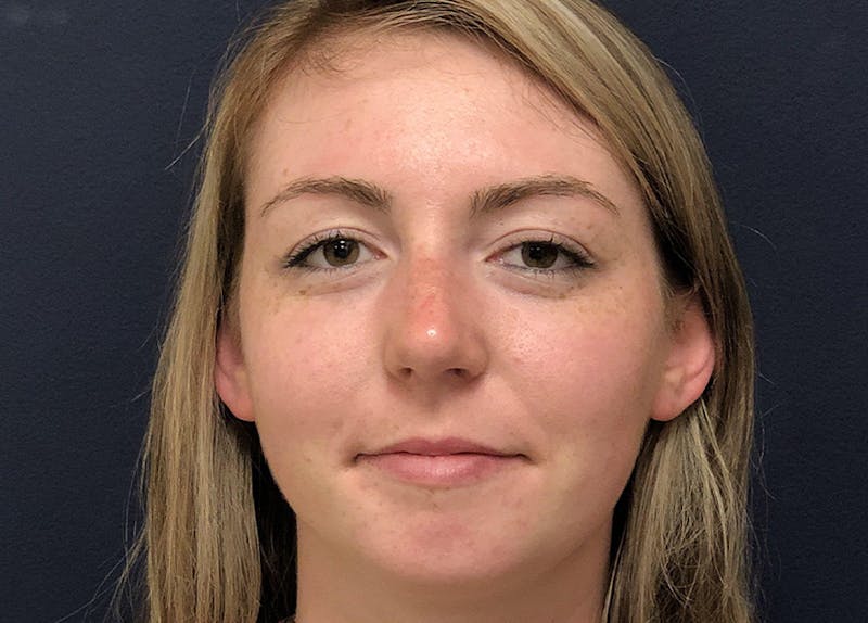 Rhinoplasty Before & After Gallery - Patient 381184 - Image 2