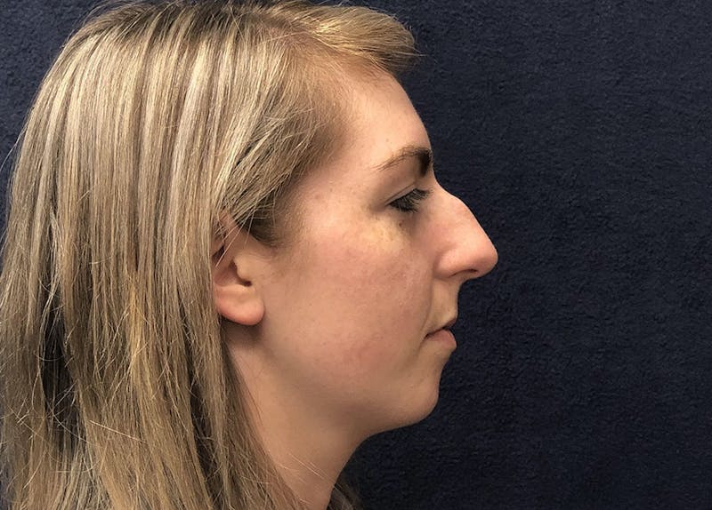 Rhinoplasty Before & After Gallery - Patient 381184 - Image 3