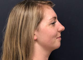 Rhinoplasty Before & After Gallery - Patient 381184 - Image 4