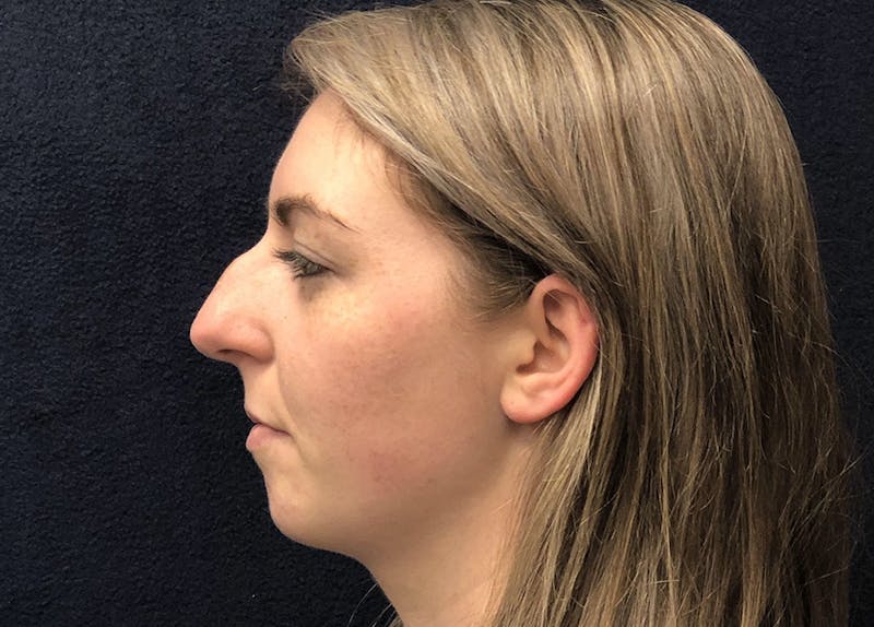 Rhinoplasty Before & After Gallery - Patient 381184 - Image 5