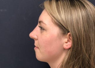 Rhinoplasty Before & After Gallery - Patient 381184 - Image 6