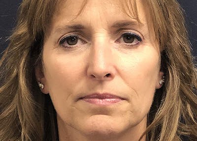 Rhinoplasty Before & After Gallery - Patient 294639 - Image 1