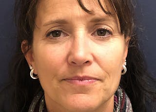 Rhinoplasty Before & After Gallery - Patient 294639 - Image 2