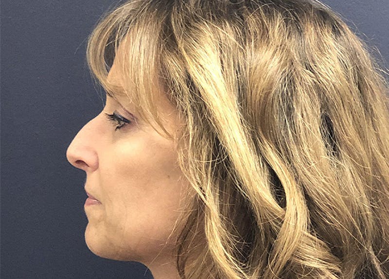 Rhinoplasty Before & After Gallery - Patient 294639 - Image 3