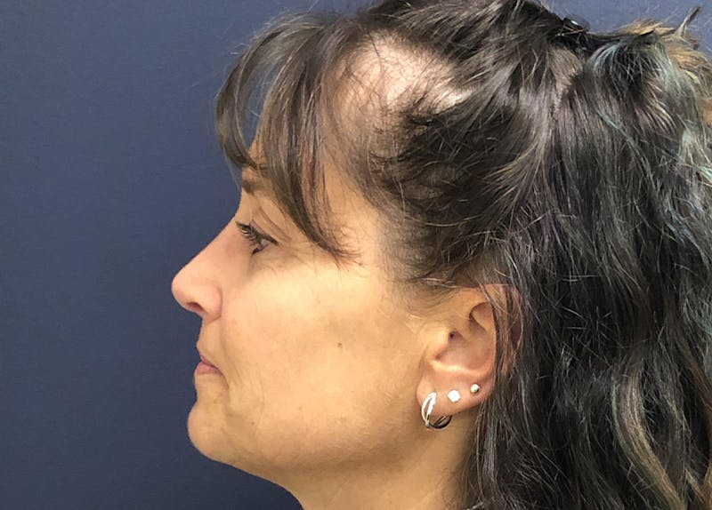 Rhinoplasty Before & After Gallery - Patient 294639 - Image 4