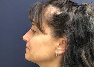Rhinoplasty Before & After Gallery - Patient 294639 - Image 4