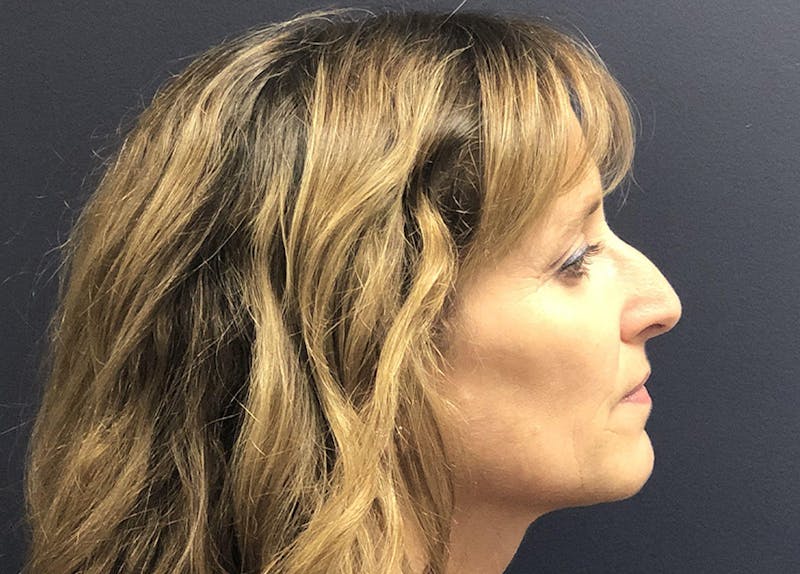 Rhinoplasty Before & After Gallery - Patient 294639 - Image 5