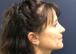 Rhinoplasty Before & After Gallery - Patient 294639 - Image 6
