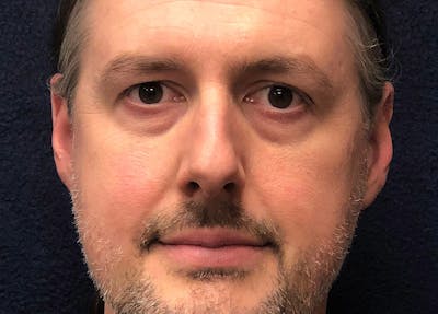 Rhinoplasty Before & After Gallery - Patient 112660 - Image 1
