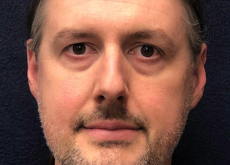 Rhinoplasty Before & After Gallery - Patient 112660 - Image 1