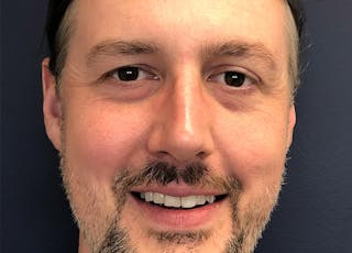 Rhinoplasty Before & After Gallery - Patient 112660 - Image 2