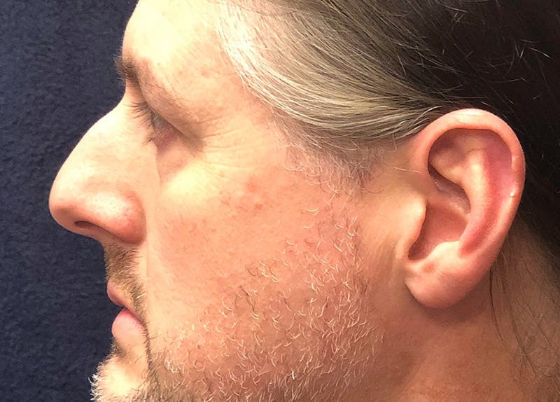 Rhinoplasty Before & After Gallery - Patient 112660 - Image 3