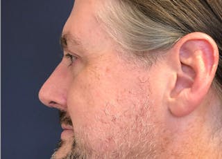 Rhinoplasty Before & After Gallery - Patient 112660 - Image 4
