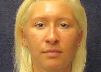 Rhinoplasty Before & After Gallery - Patient 145319 - Image 1